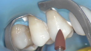 5 - L’étanchéité et l’accès en proximal sont améliorés par la mise en place de Téflon®.