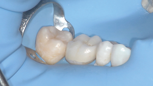 2 - Un essayage préalable de l’overlay est alors réalisé pour juger de son adaptation périphérique, de son esthétique et des contacts proximaux.