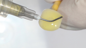 4 - On procède alors aux différents traitements de surface au niveau de l’intrados de l’overlay (Emax®) à l’aide d’acide fluorhydrique, puis silane.