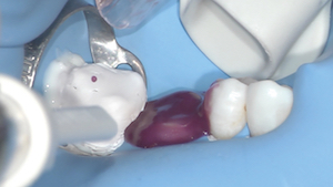 5 - Après avoir isolé la 47 à l’aide de Téflon®, la surface du moignon de la 46 ainsi que la face distale de la 45 qui présente un composite sont mordancées par de l’acide phosphorique.