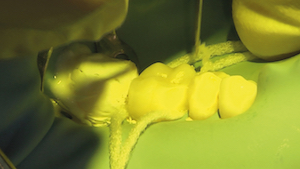 6 - Après pose de deux cordonnets mousse proximaux de type Superfloss®, l’overlay est inséré après enduction de composite conventionnel photo polymérisable réchauffé (G-aenial Anterior® de GC).