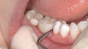 8 - Après polymérisation, prise totale du composite de collage et vérification occlusale, l’utilisation d’inserts diamantés spécifiques Komet® sur une pièce à main Soniflex® permet éventuellement de parfaire le polissage en proximal.