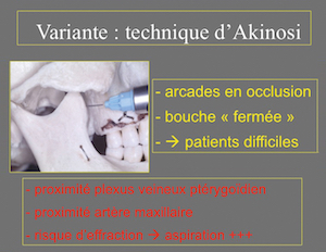 2 : Indications et risques liés à l’utilisation de la technique d’Akinosi. 