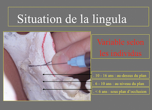 3 : Repères permettant de localiser la lingula lors de l’anesthésie à l’épine de Spix en fonction de l’âge.