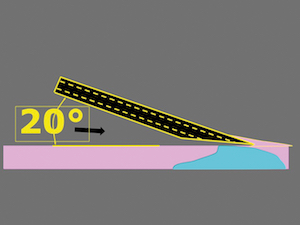 4 : Position idéale de l’aiguille pour pratiquer une injection sous-muqueuse indolore.