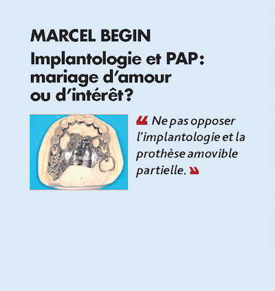 Thème n°4 par MARCEL BEGIN > Implantologie et PAP :mariage d’amour ou d’intérêt ?