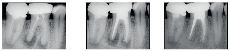 Dominique Martin  « Le retraitement endodontique, no(s) limit(es) »