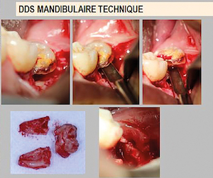 La chirurgie des dents de sagesse