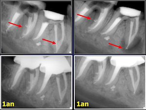 Lésions apicales et lésions endo-paro : utilisons les nouvelles technologies