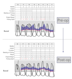 Le periodontal risk assessment est un outil ludique, pratique d’utilisation.