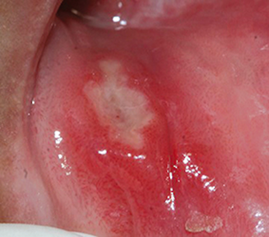 Sialometaplasia necrosante pdf to jpg