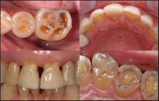 Comprendre et traiter les lésions d'usure