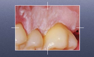 Dermatologie buccale : une compétence pour l'omnipraticien