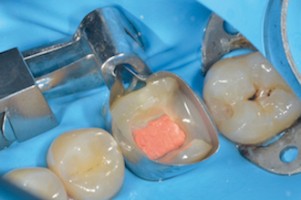 L'étanchéité coronaire, clé de la pérennité de la dent