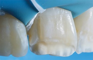 Evolutions ou Révolutions : Trucs et astuces en dentisterie esthétique