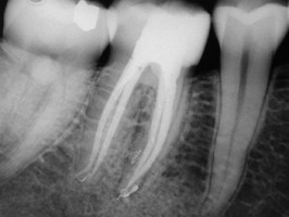 Endodontie DPC 1 jour 2024