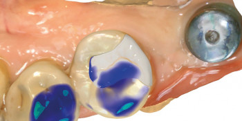 ZOOM CLINQUE N°8 : Réalisation d’un onlay céramique sur une prémolaire mandibulaire en technique directe