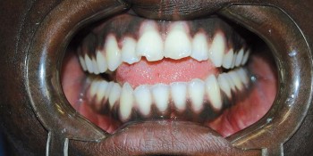 ZOOM CLINIQUE : L’orthèse d’avancée mandibulaire bibloc à enveloppe de langue : un recours thérapeutique