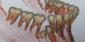 ZOOM CLINIQUE : Ankylose des molaires temporaires et agénésie de prémolaires