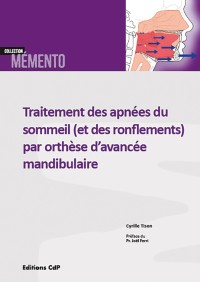 Traitement des apnées du sommeil (et des ronflements) par orthèse d'avancée mandibulaire 