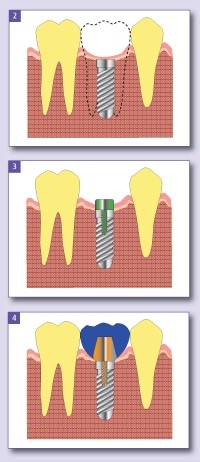 Implantologie : les implants dentaires
