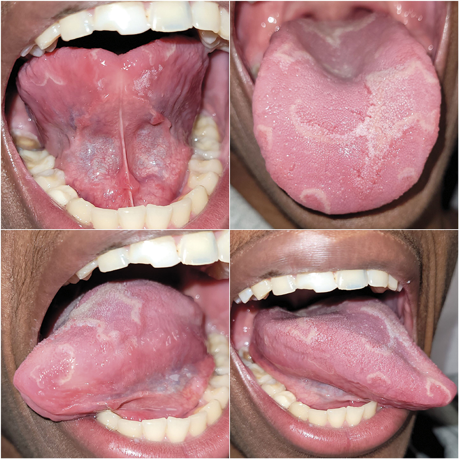 ZOOM CLINIQUE : Ma langue est bizarre : c'est grave docteur ? par ...
